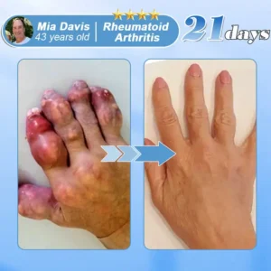 EQVP® Official Store Hyaluronic Acid Nano-microneedle Joint Patch