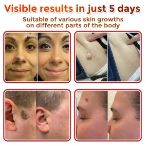 LOVILDS® MicroNeedle Botanic Skin Tag Removal Patch image LOVILDS® MicroNeedle Botanic Skin Tag Removal Patch