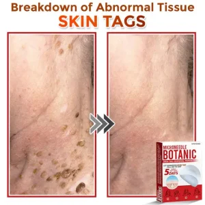 LOVILDS® MicroNeedle Botanic Skin Tag Removal Patch image LOVILDS® MicroNeedle Botanic Skin Tag Removal Patch