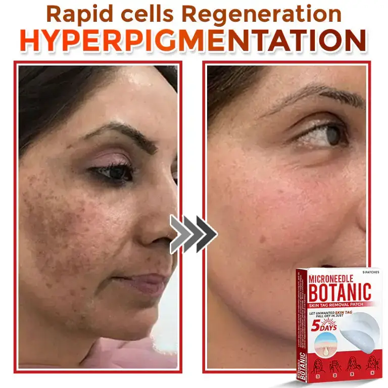 LOVILDS® MicroNeedle Botanic Skin Tag Removal Patch