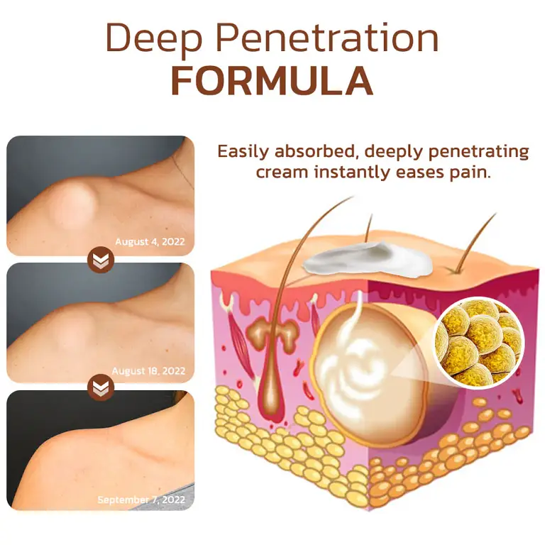 Cvreoz® Lumpless Lipoma Treatment Cream image Cvreoz® Lumpless Lipoma Treatment Cream