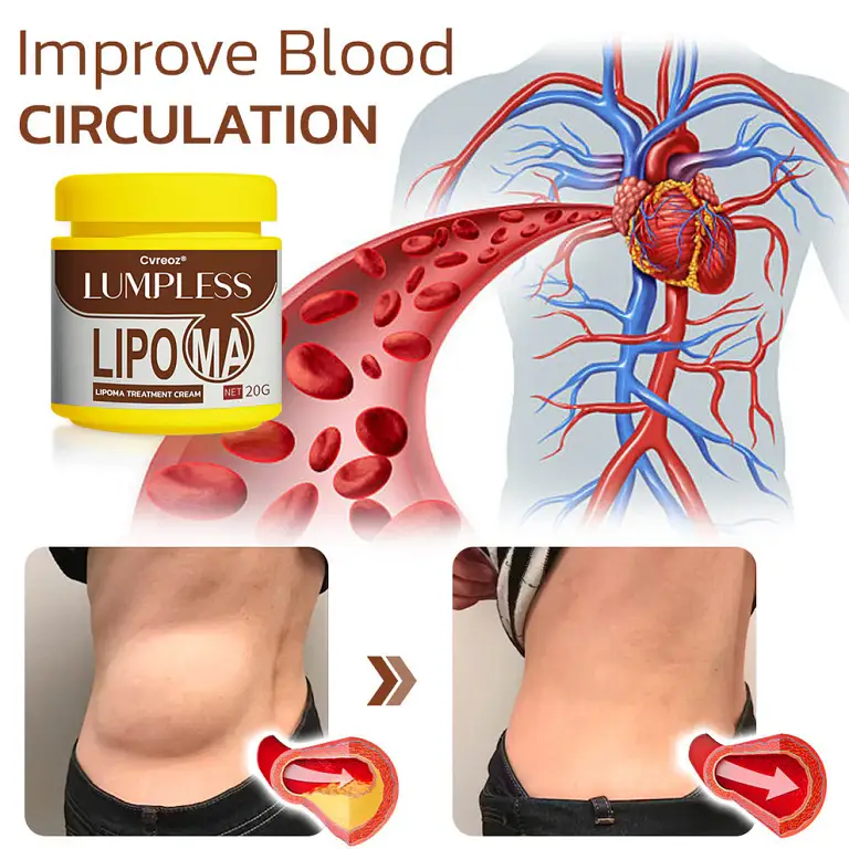 Cvreoz® Lumpless Lipoma Treatment Cream image Cvreoz® Lumpless Lipoma Treatment Cream