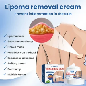 Cvreoz® Lipoma Removal Cream