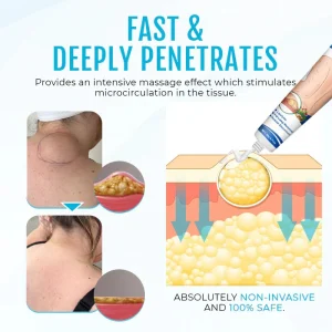 Cvreoz® Lipoma Removal Cream