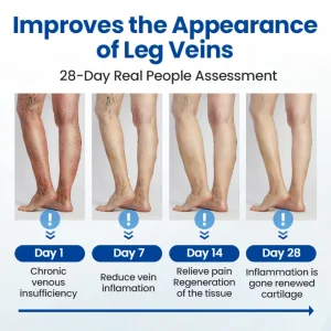 Cvreoz® Varicose Veins Patch 18 Cvreoz® Varicose Veins Patch