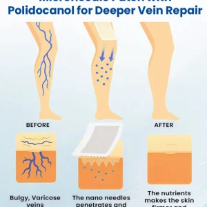 Cvreoz® Varicose Veins Patch 16 Cvreoz® Varicose Veins Patch