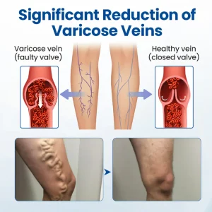 Cvreoz® Varicose Veins Patch 15 Cvreoz® Varicose Veins Patch