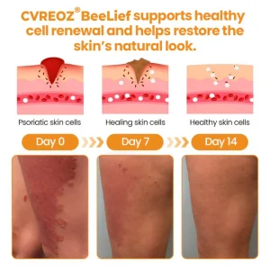 Cvreoz® BeeLief Psoriasis Skin Care Cream 11 Cvreoz® BeeLief Psoriasis Skin Care Cream