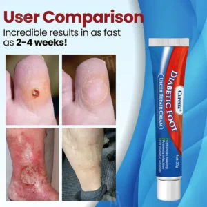 Cvreoz® Diabetic Foot Ulcer Repair Cream