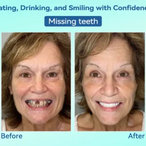 DIYSTAR™ Premium Denture image DIYSTAR™ Premium Denture