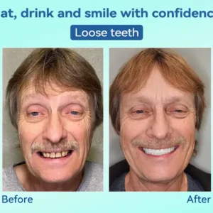 DIYSTAR™ Premium Denture image DIYSTAR™ Premium Denture