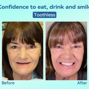 DIYSTAR™ Premium Denture image DIYSTAR™ Premium Denture