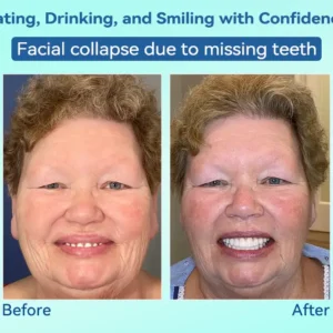 DIYSTAR™ Premium Denture image DIYSTAR™ Premium Denture