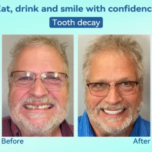 DIYSTAR™ Premium Denture image DIYSTAR™ Premium Denture