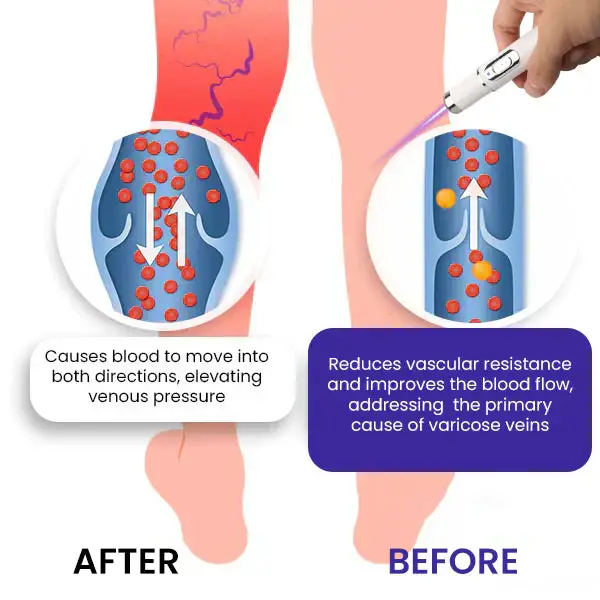 Bikenda® Varicose Vein Photothermal Laser Treatment