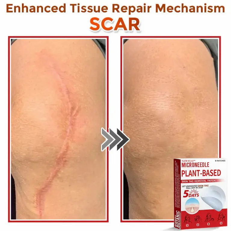 Newyuo® MicroNeedle Botanic Skin Tag Removal Patch