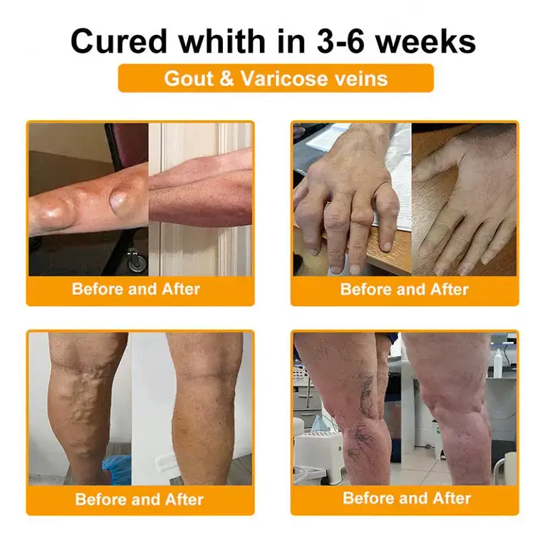 ADFIRE® Bee Venom Pain-Relief Bone Healing Spray