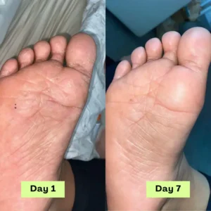 NEGUSY™ Tea Tree Athlete’s Foot Defense Soap