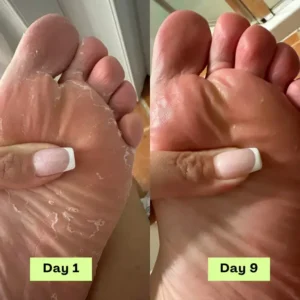 NEGUSY™ Tea Tree Athlete’s Foot Defense Soap