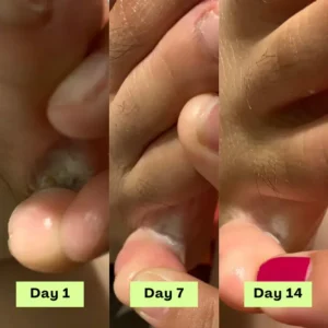 NEGUSY™ Tea Tree Athlete’s Foot Defense Soap