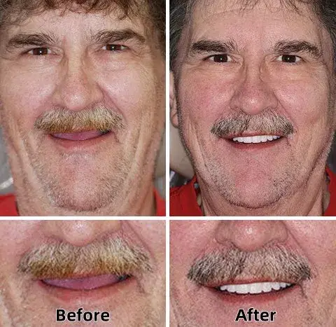 Tenowsy™-Advanced Custom-Fit Functional Dentures 6 Tenowsy™-Advanced Custom-Fit Functional Dentures
