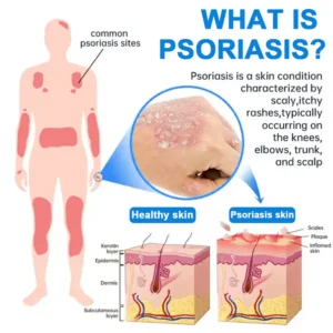 Zvoevo®Magnesium Herbal Psoriasis Spray image Zvoevo®Magnesium Herbal Psoriasis Spray