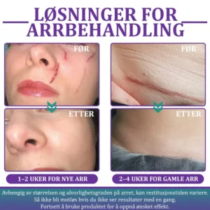 Flysmus® ReGen Hyaluronic Acid Nano-Heal Microneedle Tape