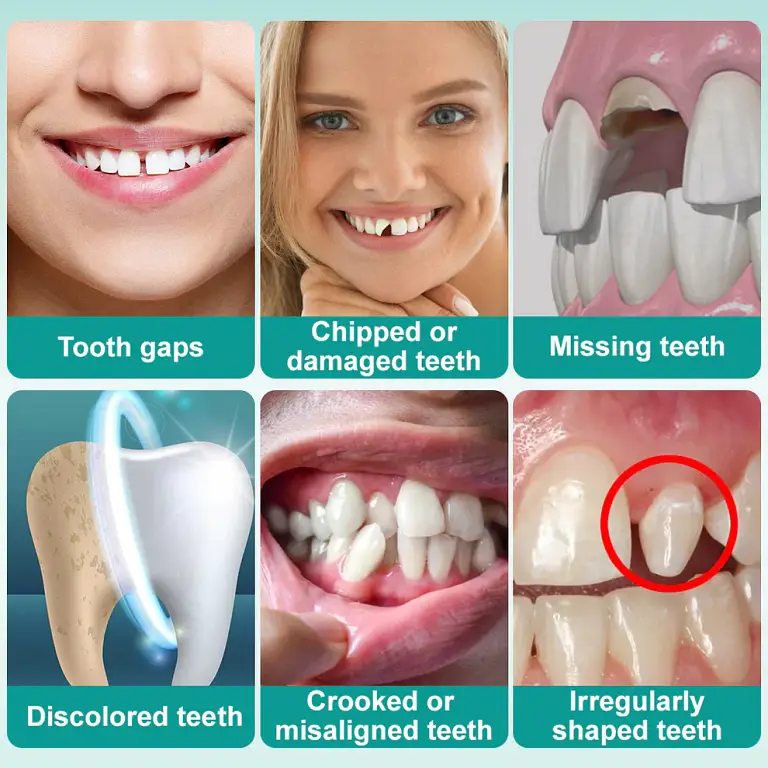 Ourlyard® Instant Stick on Dental Veneers image Ourlyard® Instant Stick on Dental Veneers