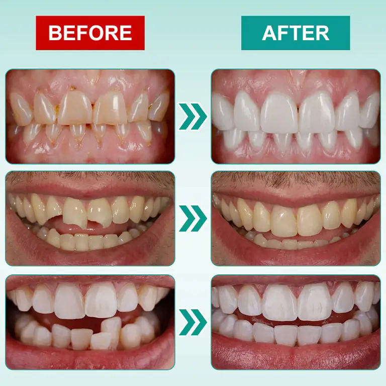 Ourlyard® Instant Stick on Dental Veneers image Ourlyard® Instant Stick on Dental Veneers