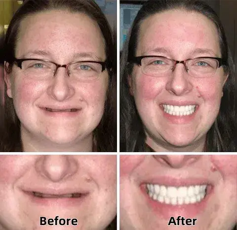 Tenowsy™-Advanced Custom-Fit Functional Dentures 5 Tenowsy™-Advanced Custom-Fit Functional Dentures
