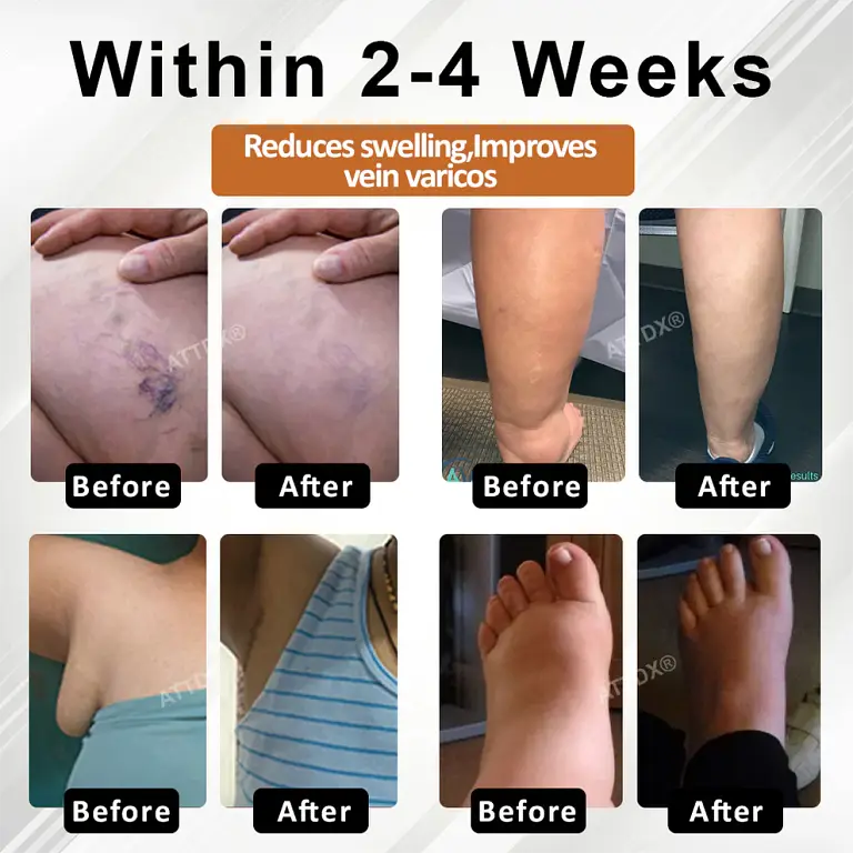 ATTDX® ManukaRelief Edema Therapy Cream