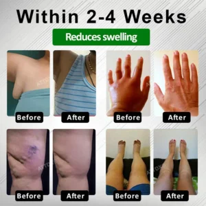 ATTDX® PuffyGone Horse Chestnut Edema Cream image ATTDX® PuffyGone Horse Chestnut Edema Cream