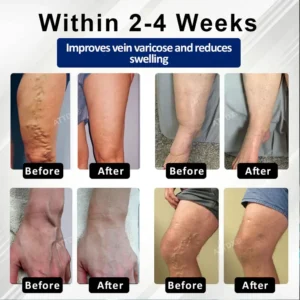 Cvreoz® VeinFocus Microneedle Leg Patch