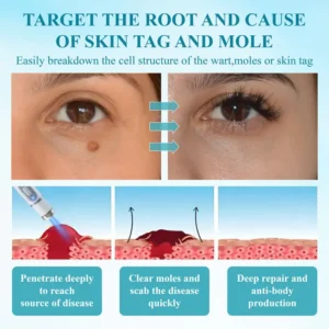 RICPIND® DermaLite Mole and Wart Removal Laser Pen