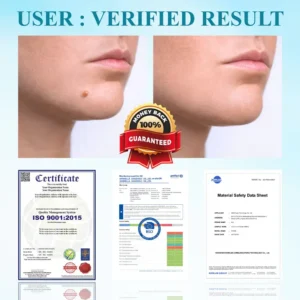 RICPIND® DermaLite Mole and Wart Removal Laser Pen