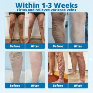 Cvreoz® VeinErase MicroNeedle Repair Patch image Cvreoz® VeinErase MicroNeedle Repair Patch