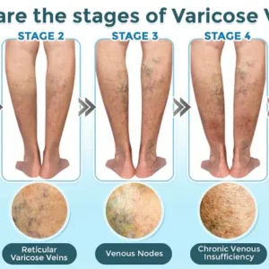 GFOUK® VenaRestore MicroNeedle Vein Repair Patch image GFOUK® VenaRestore MicroNeedle Vein Repair Patch