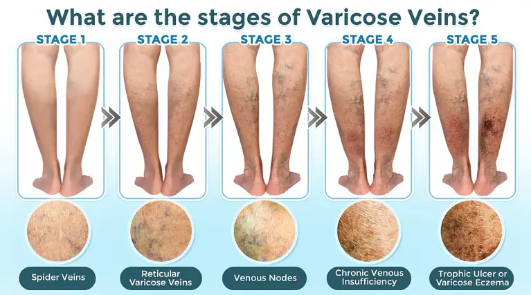 GFOUK® VenaRestore MicroNeedle Vein Repair Patch