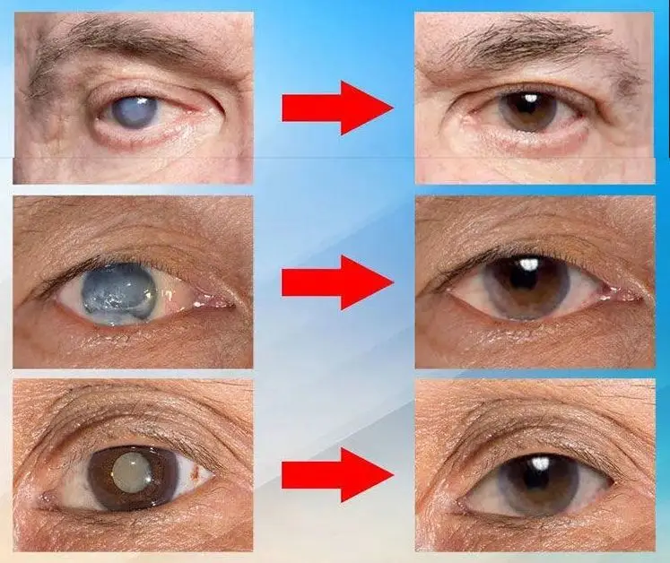 Japan Vision Drops — Rapidly Heals All Eye Conditions & Restores Vision