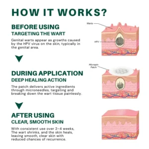 ODALIT™ Genital Wart Removal Patch