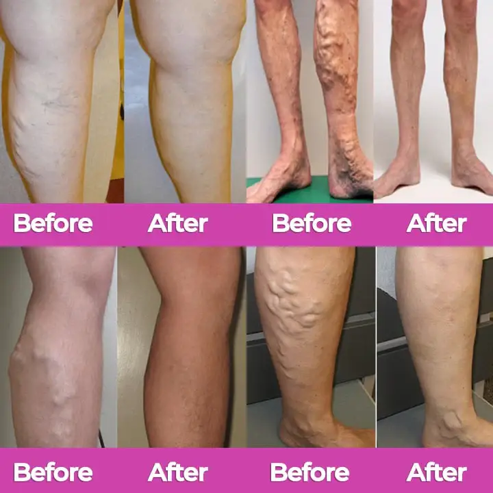 CVREOZ® VeinFlow Advanced Varicose Vein Patch