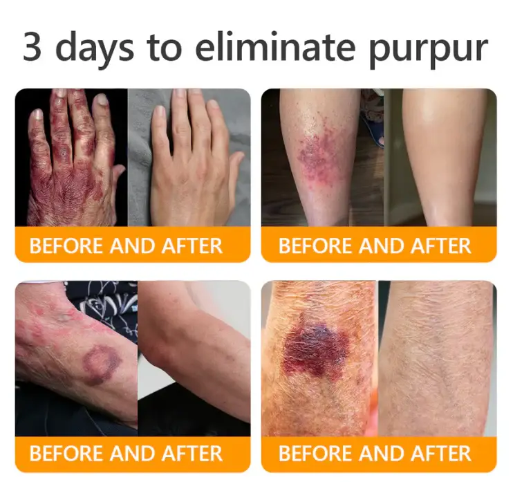 Daasry® Bee Venom Treatment Cream