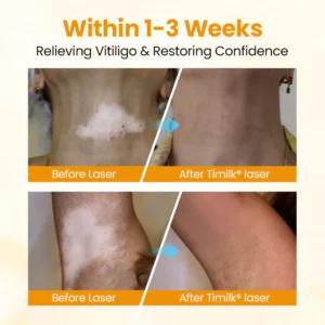 Timilk® VitiGone Rapid Spray — 2–3 Week Repigmentation with OTDS