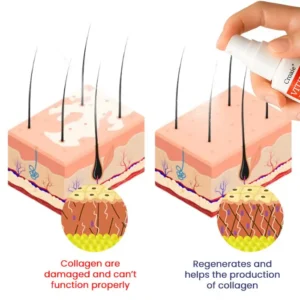 Croaie® Vitiligo Treatment Spray – No allergies