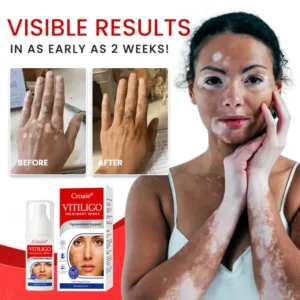 Croaie® Vitiligo Treatment Spray – No allergies