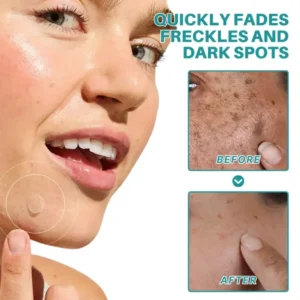 Fivfivgo® Botanical Freckles & Spot Removal Patch image Fivfivgo® Botanical Freckles & Spot Removal Patch