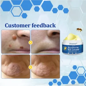 Zvoevo® BeeDerm RX Cream, Painless, Targeted Treatment for Warts 11 Zvoevo® BeeDerm RX Cream, Painless, Targeted Treatment for Warts