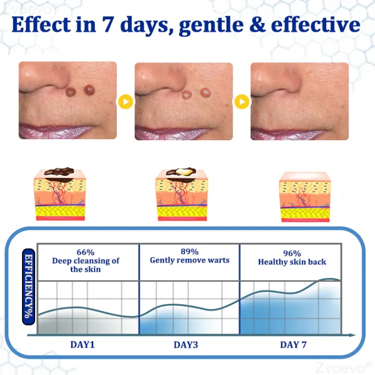 Zvoevo® BeeDerm RX Cream, Painless, Targeted Treatment for Warts 5 Zvoevo® BeeDerm RX Cream, Painless, Targeted Treatment for Warts