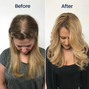 Biancat® Maximum Strength 5% Minoxidil Fast-Action Hair Growth Serum