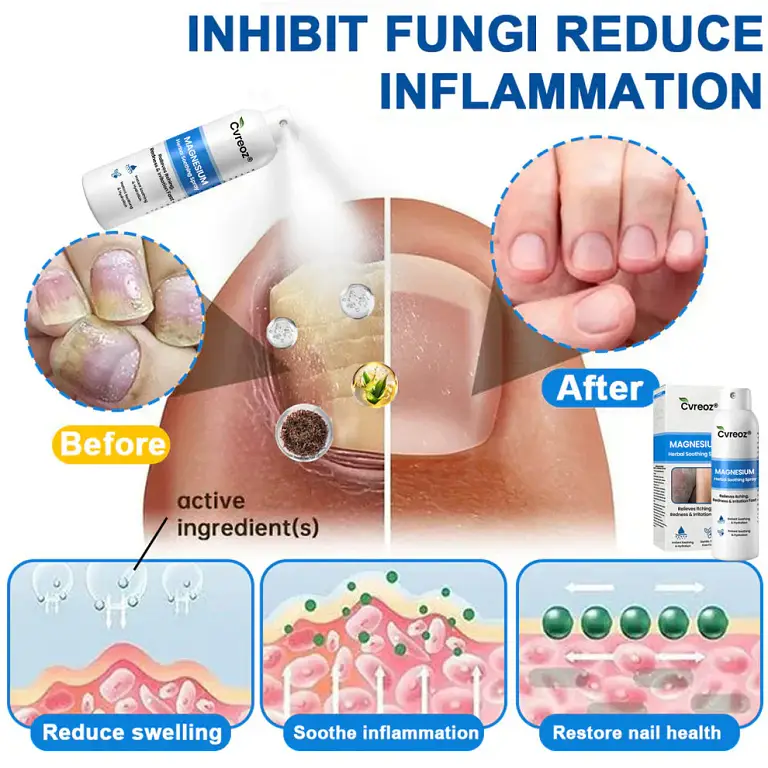 Cvreoz® Magnesium Herbal Psoriasis Spray